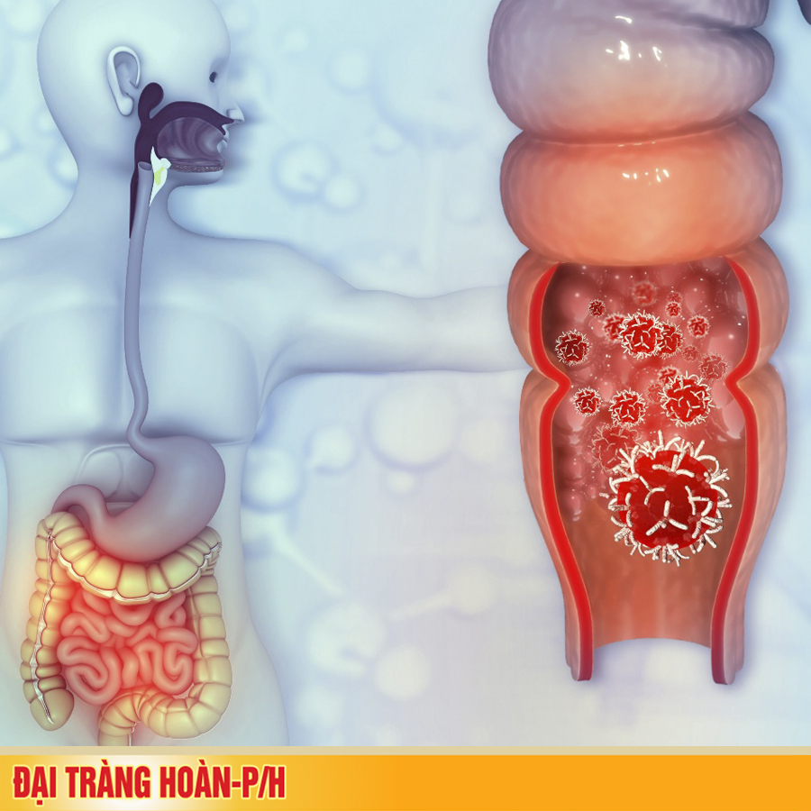 Viêm đại tràng cấp tính - “Bệnh từ cái miệng”
