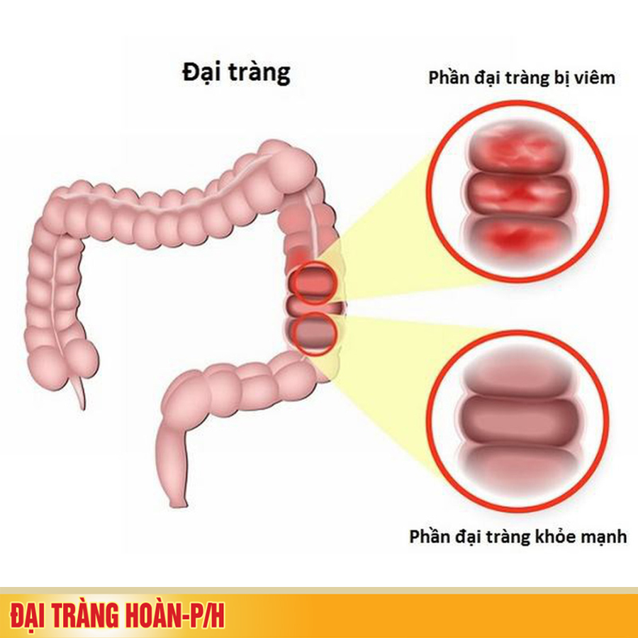 Tại sao cần phải chữa dứt điểm bệnh đại tràng cấp tính?
