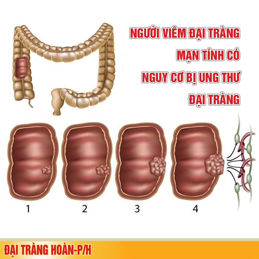 NHỮNG BIẾN CHỨNG CỦA BỆNH VIÊM ĐẠI TRÀNG MẠN TÍNH
