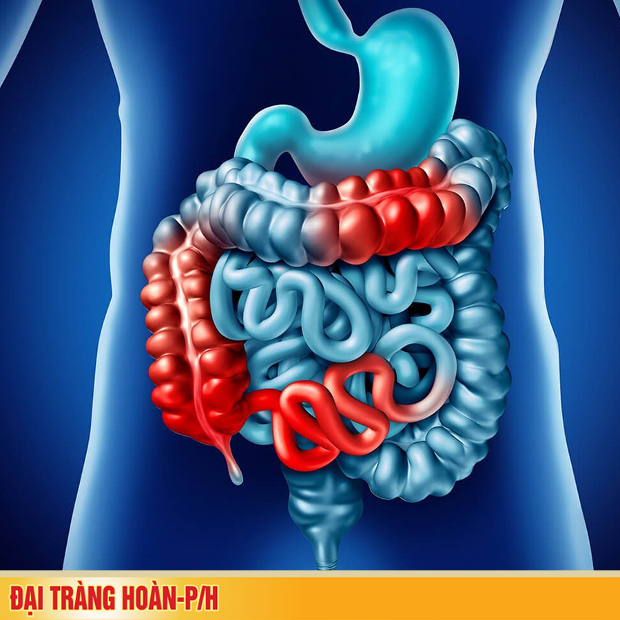 Triệu chứng bệnh viêm đại tràng mạn tính bạn cần biết