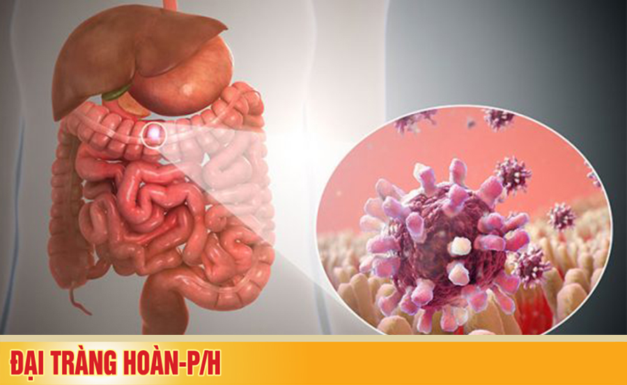 Kiến thức cần biết về viêm đại tràng cấp tính