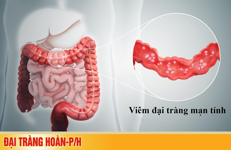 Truy tìm thủ phạm gây bệnh viêm đại tràng mạn tính