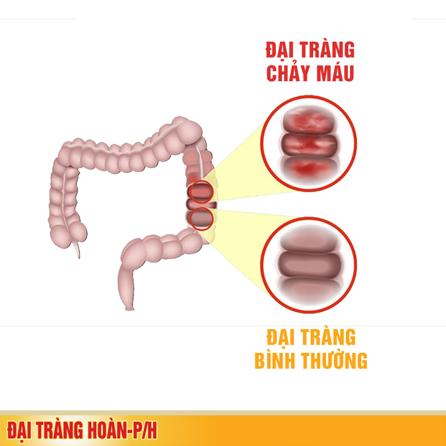 Viêm loét đại trực tràng chảy máu - Chẩn đoán sớm để phòng biến chứng nguy hiểm